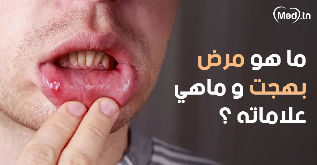 ماهو مرض بهجت و ماهي علاماته ؟